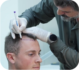 hair transplant turkey