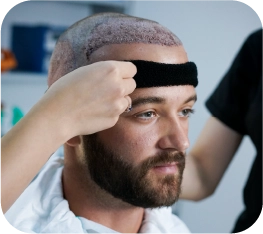 hair transplant turkey